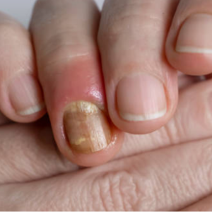 paroniquia enfermedad de uñas 
